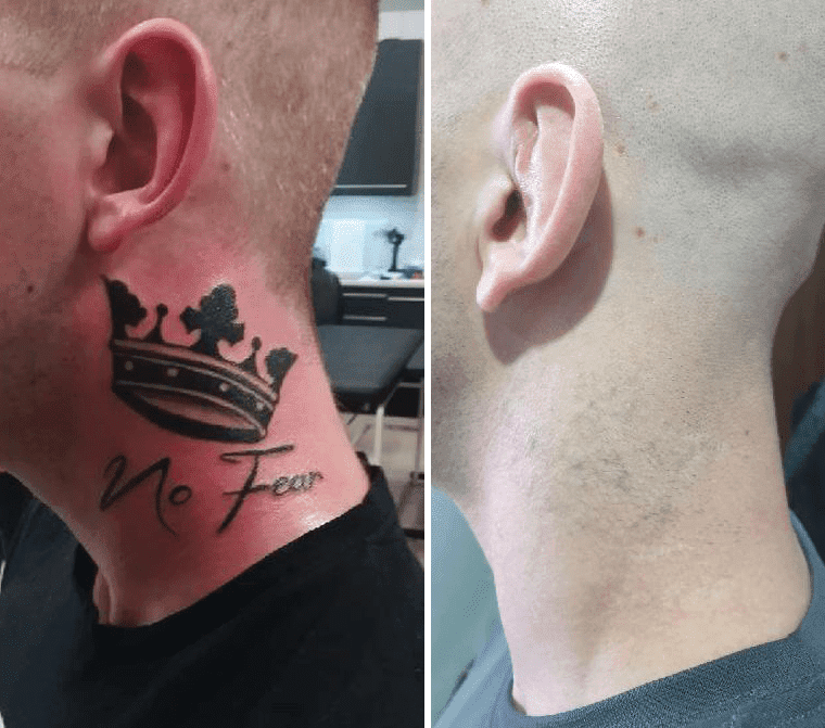 usuwanie-tatuazu-keramed