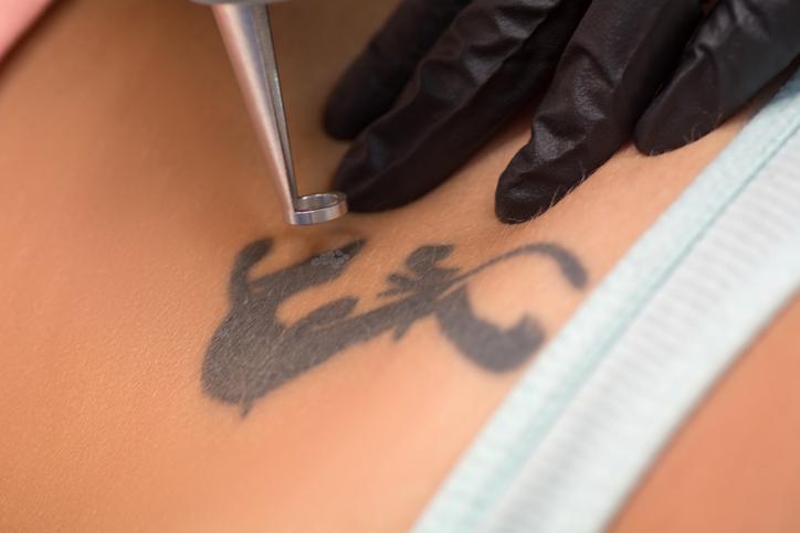 usuwanie tatuazu