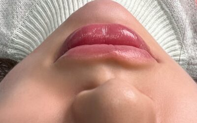 Powiększanie ust a&nbsp;kształt twarzy – co&nbsp;warto dopasować?